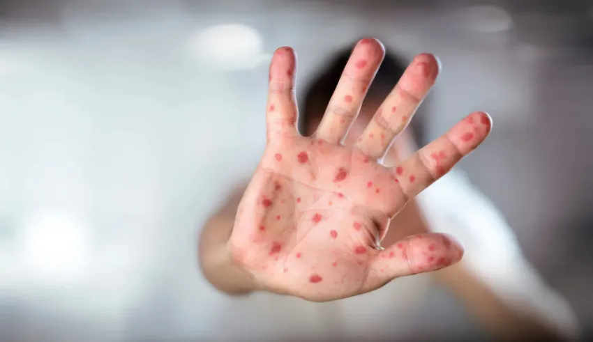 CAN 2025 au Maroc : une crise sanitaire assombrit le tirage au sort