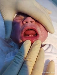 Bébé irakien atteint d'une maladie rare, examiné par un professionnel de santé.