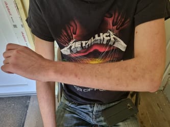 Personne montrant une piqûre de punaises de lit sur le bras.