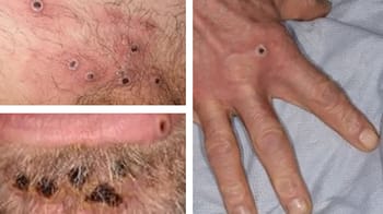 Les lésions de la variole du singe sur la peau humaine.