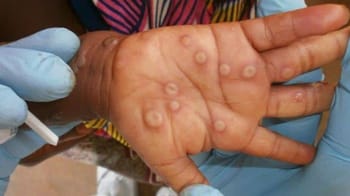 Symptômes de la variole du singe sur la main avec boutons et lésions.