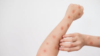 Éruption cutanée de variole du singe sur le bras.